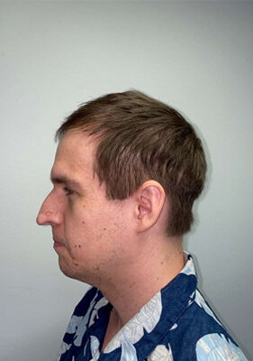 hair transplant photos