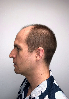 hair transplant photos