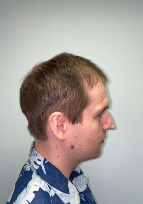 hair transplant before after Photos