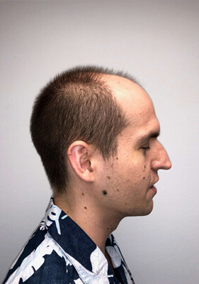 hair transplant before after Photos