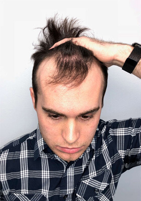 hair transplant before after Photos