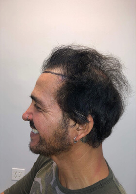 hair transplant before after Photos