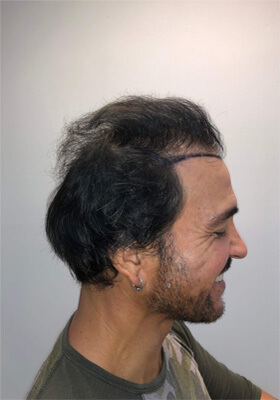 hair transplant before after Photos