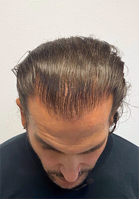 hair transplant before after Photos