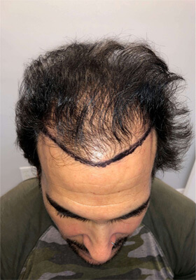 hair transplant before after Photos