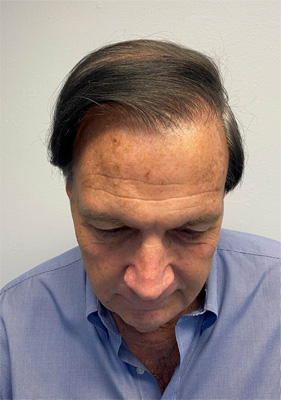 hair transplant before after Photos