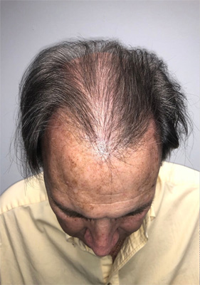 hair transplant before after Photos