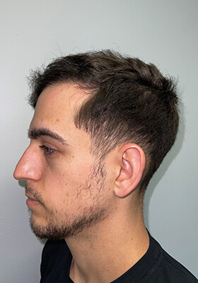 hair transplant before after Photos