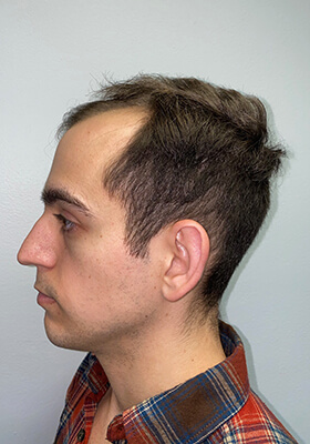 hair transplant before after Photos