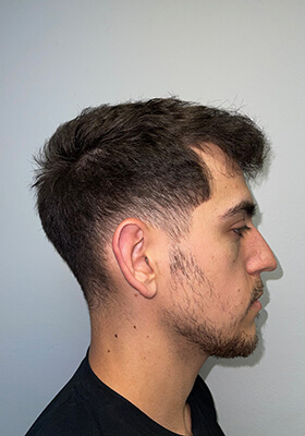 hair transplant before after Photos