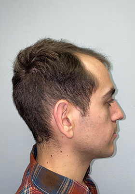 hair transplant before after Photos