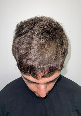 hair transplant before after Photos