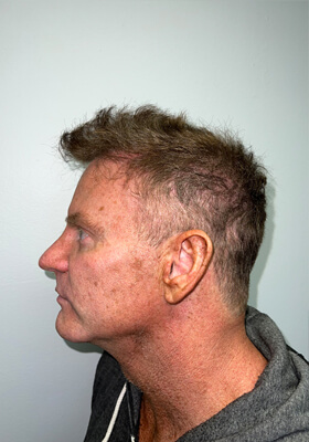 hair transplant before after Photos