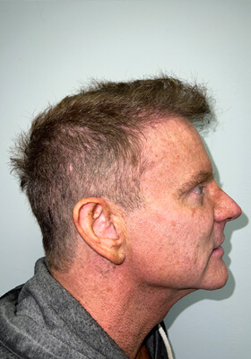 hair transplant before after Photos