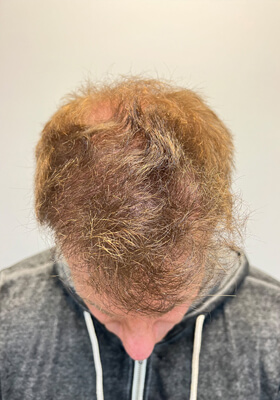 hair transplant before after Photos