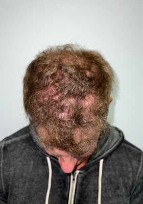 hair transplant before after Photos