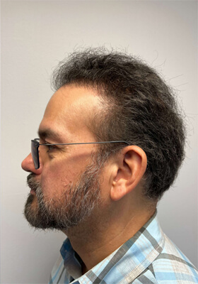 hair transplant before after Photos