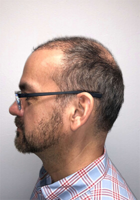 hair transplant before after Photos