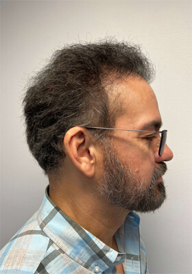 hair transplant before after Photos