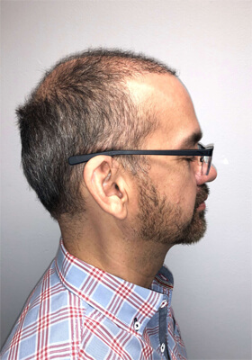 hair transplant before after Photos