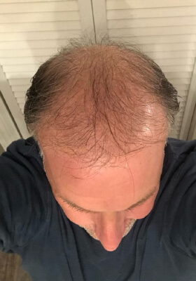 hair transplant before after Photos