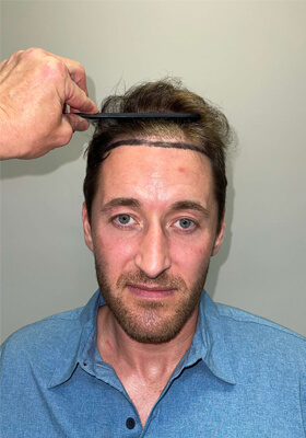 hair transplant photos