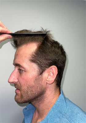 hair transplant photos