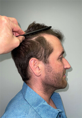 hair transplant photos