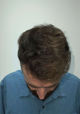 hair transplant photos