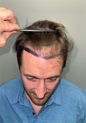 hair transplant before after Photos