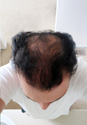 hair transplant before after Photos