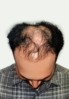 hair transplant photos