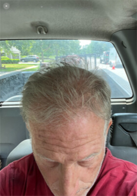 hair transplant photos