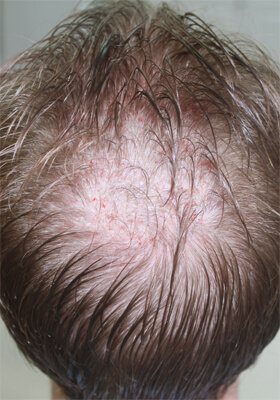 hair transplant photos