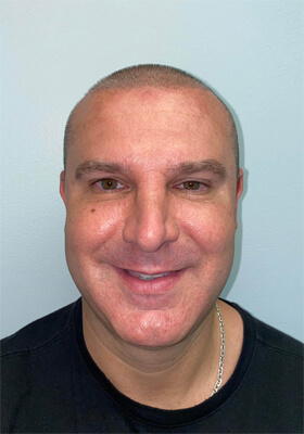 hair transplant photos