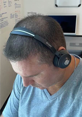 hair transplant photos