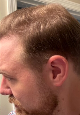 hair transplant photos