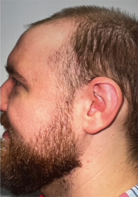 hair transplant photos