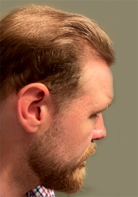 hair transplant before after Photos