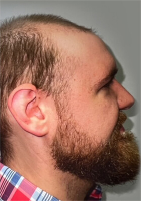 hair transplant photos