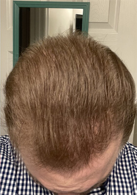 hair transplant before after Photos