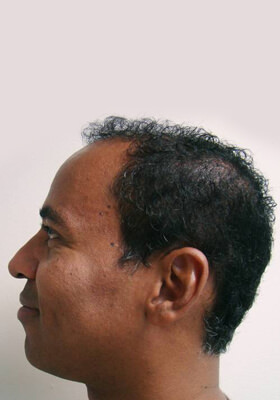 hair transplant photos