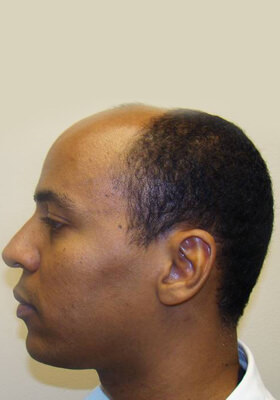 hair transplant before after Photos