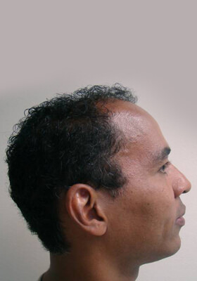 hair transplant before after Photos