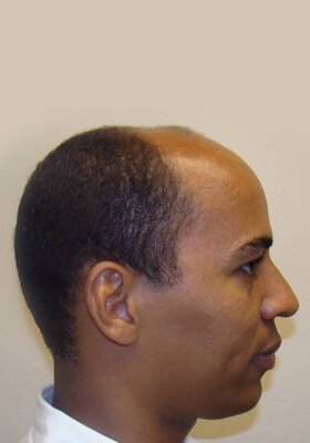 hair transplant before after Photos