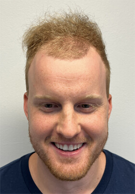 hair transplant photos