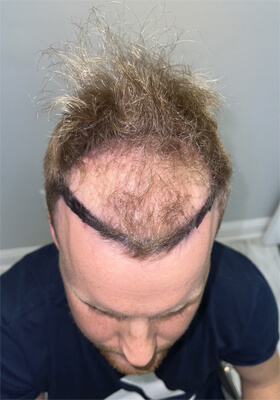 hair transplant photos