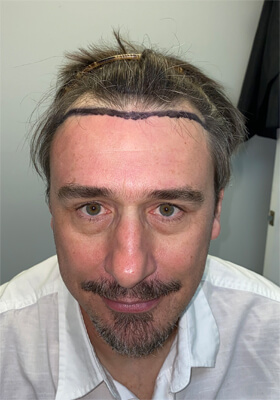 hair transplant photos