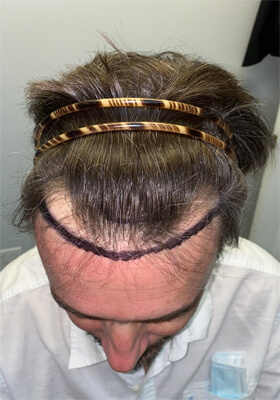 hair transplant before after Photos