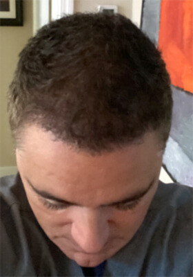 hair transplant photos